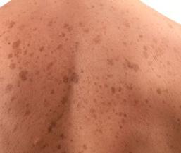 Солнечный лишай