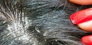 Зуд кожи головы лечение