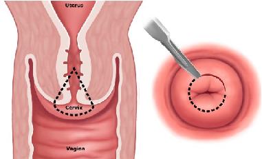 конизация шейки матки