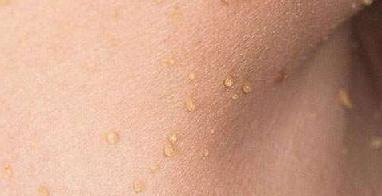 висячие родинки фото