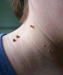 висячие родинки лечение