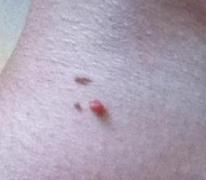 висячие родинки