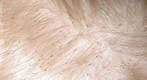 вши на голове