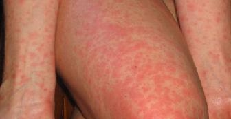 Аллергия на коже фото начало