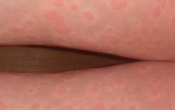 Аллергия на коже лечение