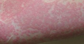 Аллергия на коже