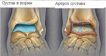 Артроз голеностопного сустава симптомы