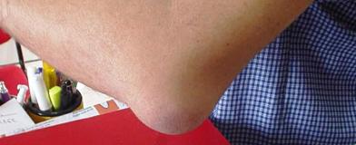 Бурсит локтевого сустава фото