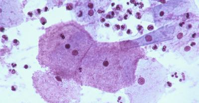 Гарднерелла у женщин симптомы