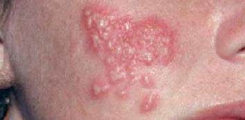 Герпес на лице лечение