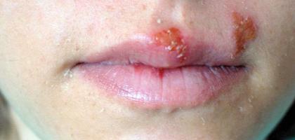 Герпес на лице