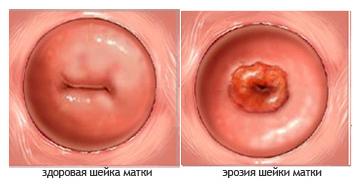Эрозия шейки матки фото