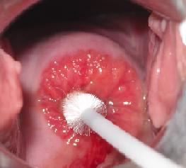 Эрозия шейки матки лечение