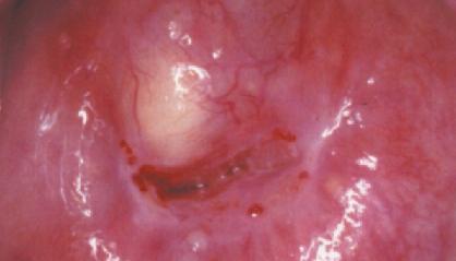 Киста шейки матки фото