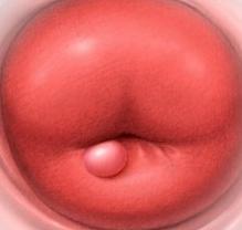 Киста шейки матки