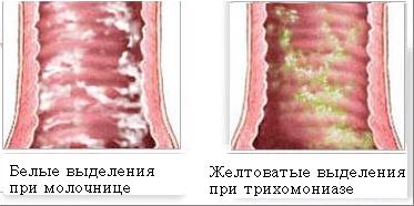 Молочница у женщин фото