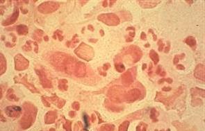 Уреаплазма у мужчин фото