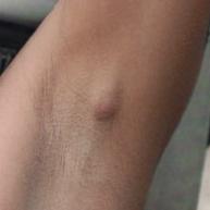 Воспаление лимфоузлов под мышкой