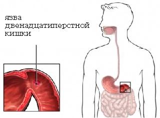 Язва двенадцатиперстной кишки симптомы