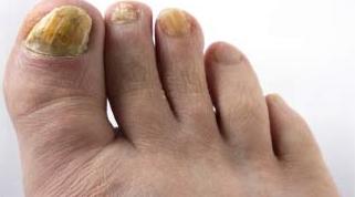 грибок ногтей на ногах фото 2