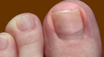 грибок ногтей на ногах фото