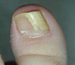 как лечить грибок ногтей на ногах