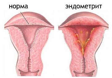 коричневые выделения у женщин причины