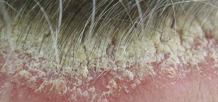 псориаз на голове