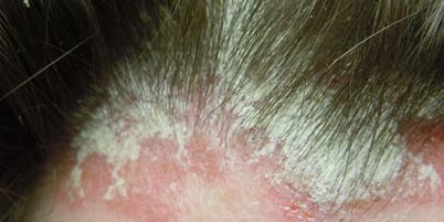 псориаз волосистой части головы фото