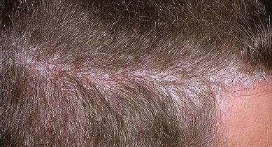 псориаз волосистой части головы лечение