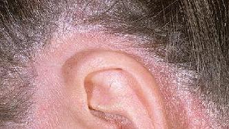 псориаз волосистой части головы