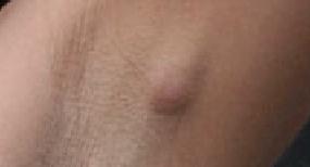 увелечение лимфоузлов под мышкой