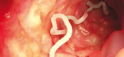 зуд в заднем проходе глисты