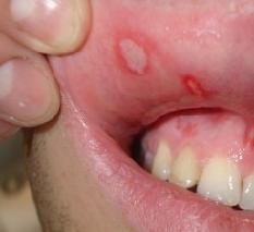 Афтозный стоматит