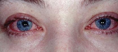 Аллергический конъюнктивит фото