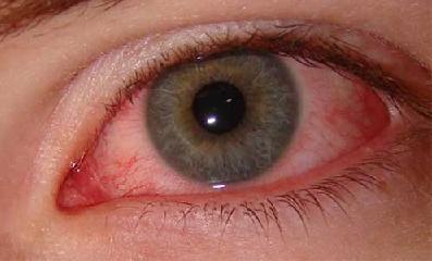 Аллергический конъюнктивит симптомы