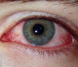 Аллергический конъюнктивит