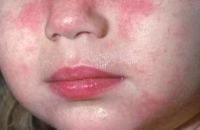 Атопический дерматит фото