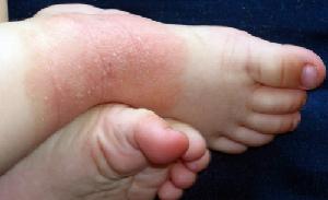 Атопический дерматит