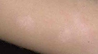 Белый лишай