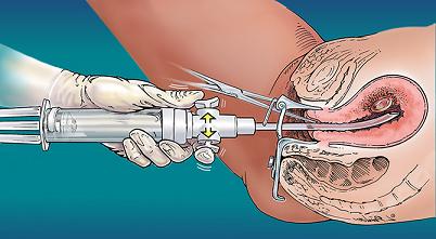 Биопсия шейка матки как проводят
