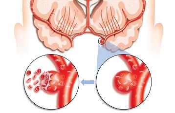 Геморрагический инсульт фото