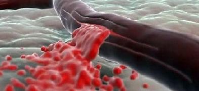 Геморрагический инсульт лечение