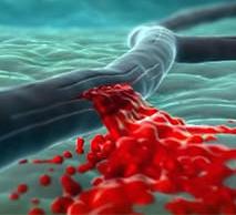 Геморрагический инсульт