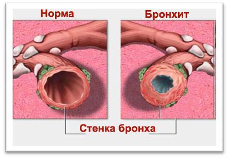 Хронический бронхит причины