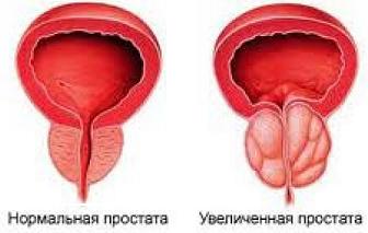 Хронический простатит симптомы