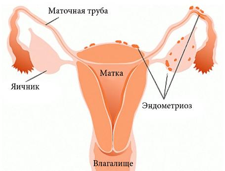 Эндометриоз причины