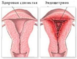 Эндометриоз симптомы