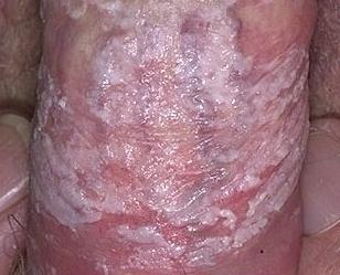 Кандидоз у мужчин фото