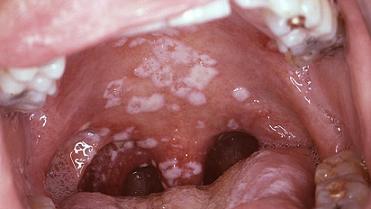 Кандидозный стоматит фото